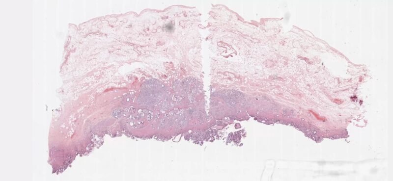Gallbladder carcinoma