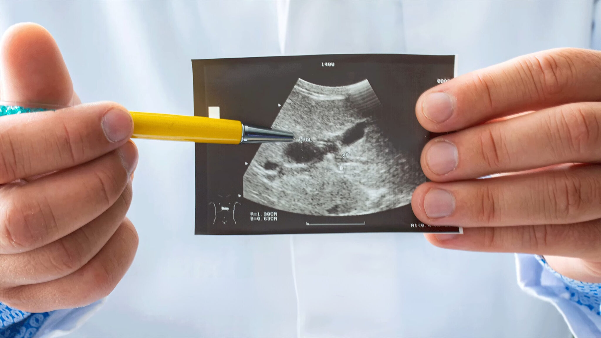 What is calculus of gallbladder with acute cholecystitis exploring