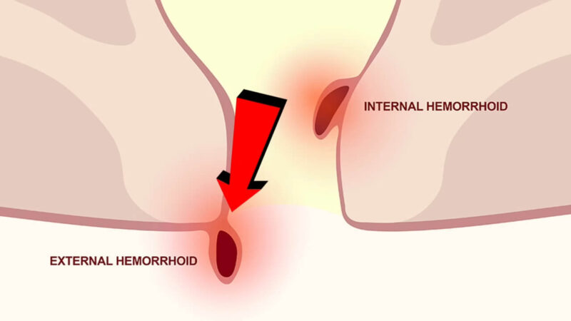 Internal and External Hemorrhoid