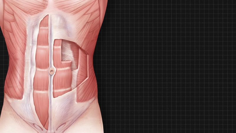 Medical illustration of abdominal muscles showing obliques and rectus abdominis, often linked to lower rib pain from muscle overload