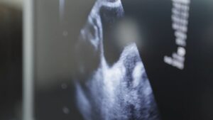 AFC Ultrasound Count: How It Works, What Numbers Tend To Signal, What ...