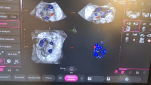 AFC Ultrasound Count: How It Works, What Numbers Tend To Signal, What ...