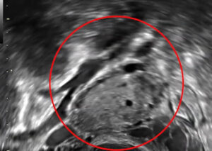 AFC Ultrasound Count: How It Works, What Numbers Tend To Signal, What ...