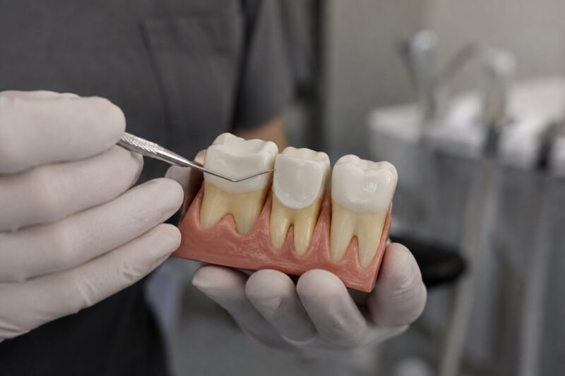 Dentist pointing to a tooth model during a discussion about composite bonding.